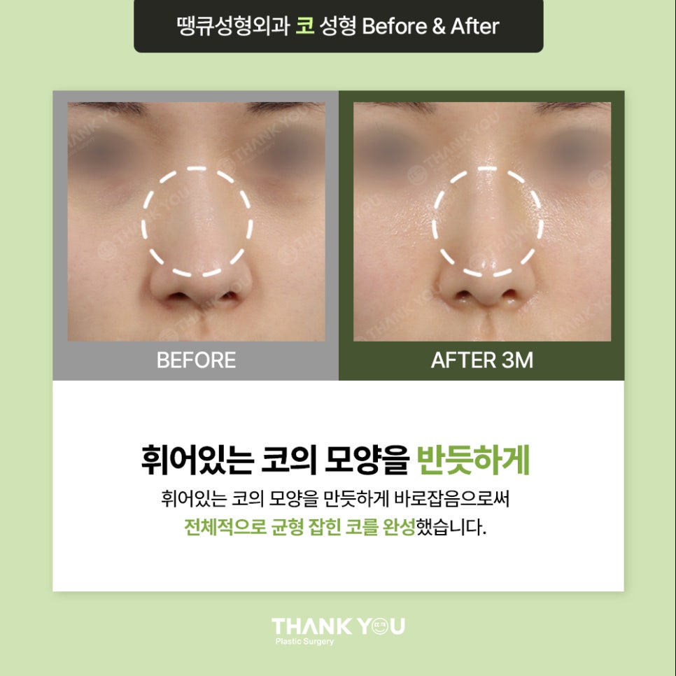 코수술, 모양에 따른 디자인이 중요 포인트 관련 이미지 7