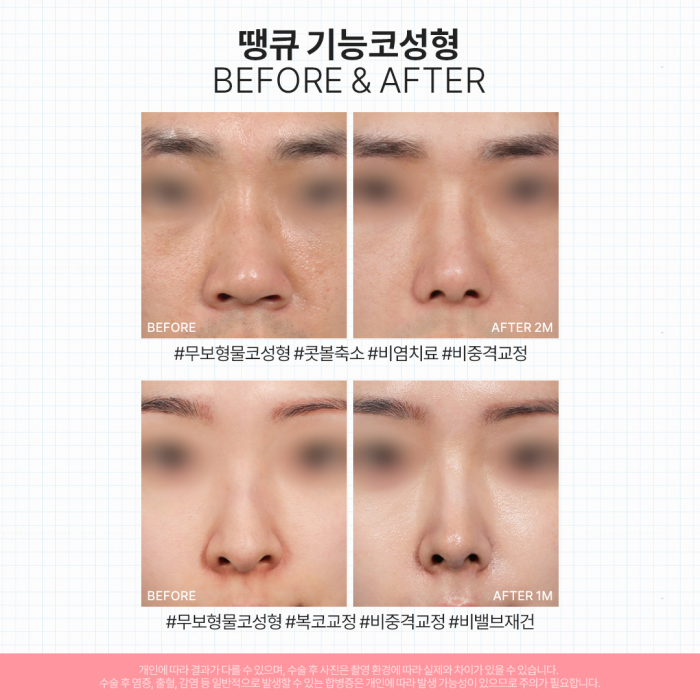 비염기능코수술과 미용코 성형을 동시에! 기능코성형 효과는?! 관련 이미지 9