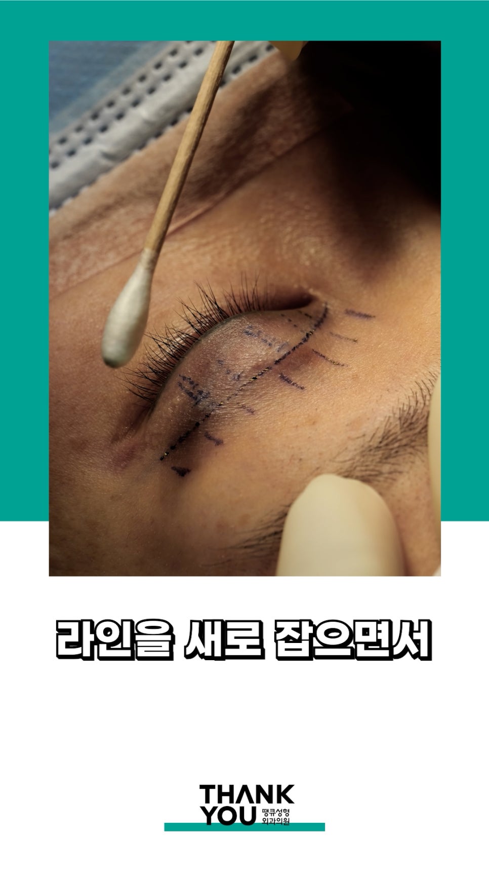 3번 눈재수술? 근데 실제거를 안했다고? 땡큐에서 전부 실제거! 관련 이미지 14