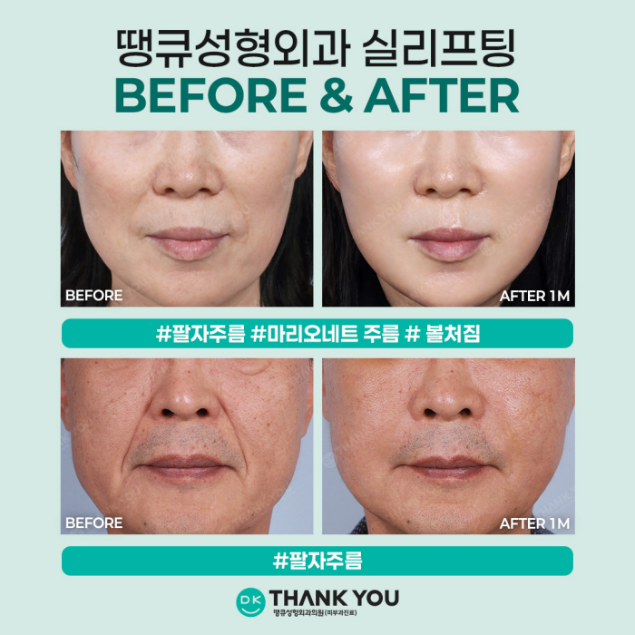 If You Want to Create a Noticeable Difference Before and After Face Thread Lifting image 9