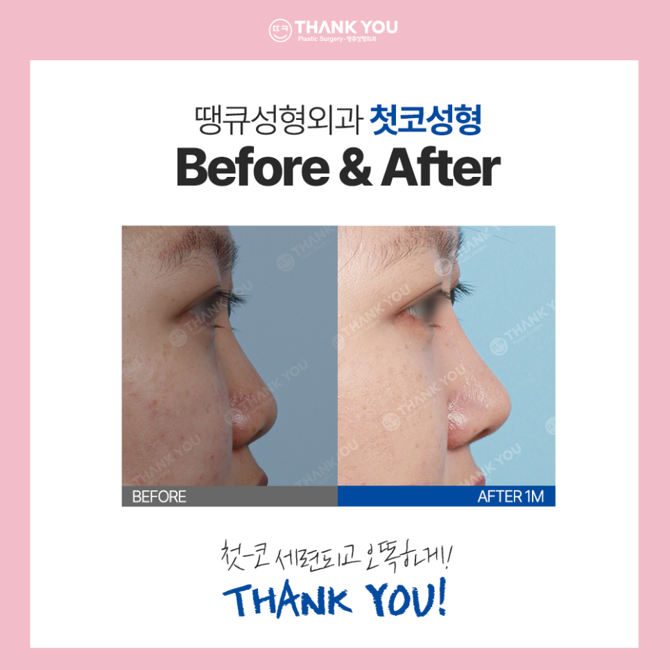 수능 끝나면 수험생 버킷리스트? 수험생 눈코 성형 전후Check 관련 이미지 12