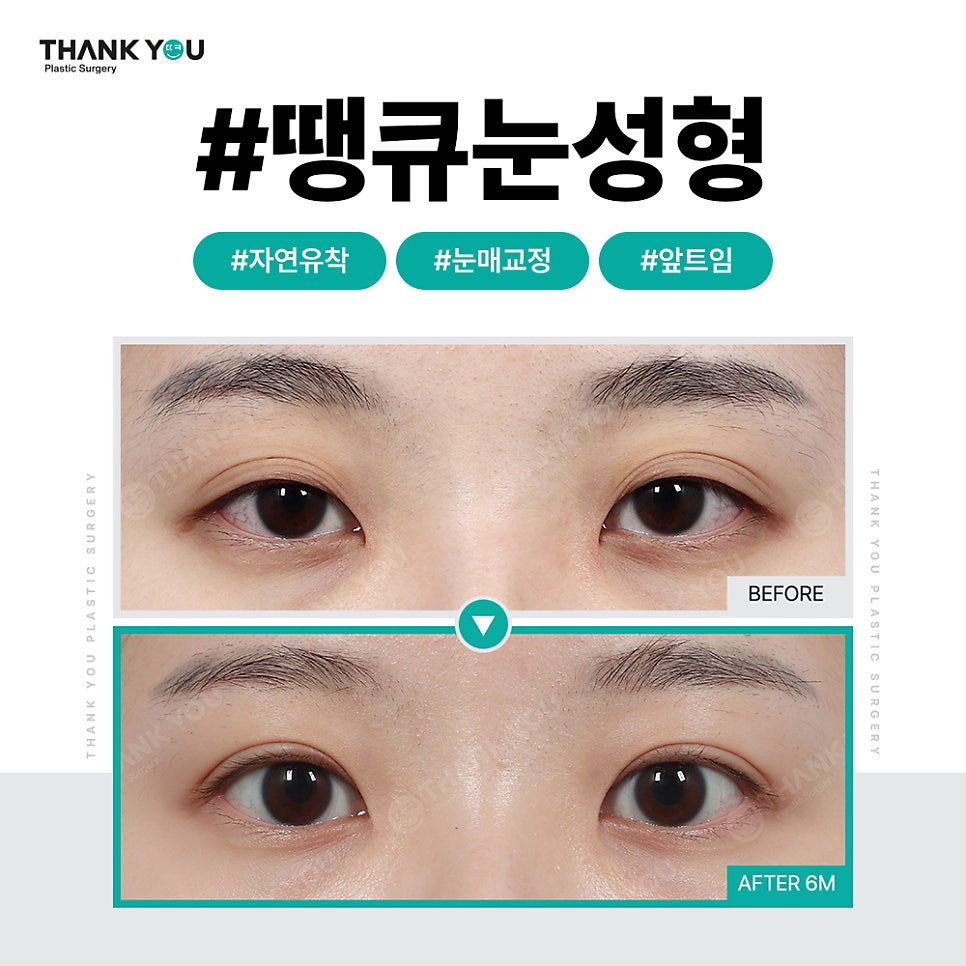 쌍꺼풀 라인 종류, 내게 맞는 쌍수랑 트임은?(인라인) 관련 이미지 2