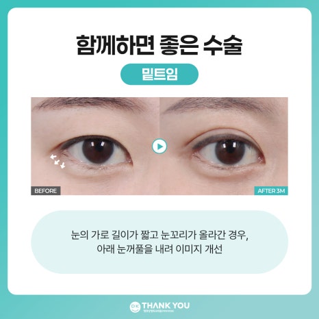 비절개 눈매교정 vs 절개 눈매교정 뭐가 다를까? 관련 이미지 13