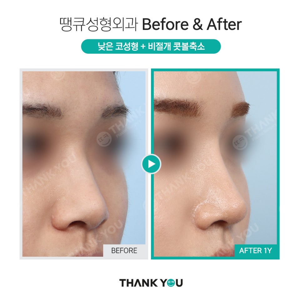 코성형, 비공내리기 수술이란? [콧구멍 잘 보이는 용코 개선] 관련 이미지 8
