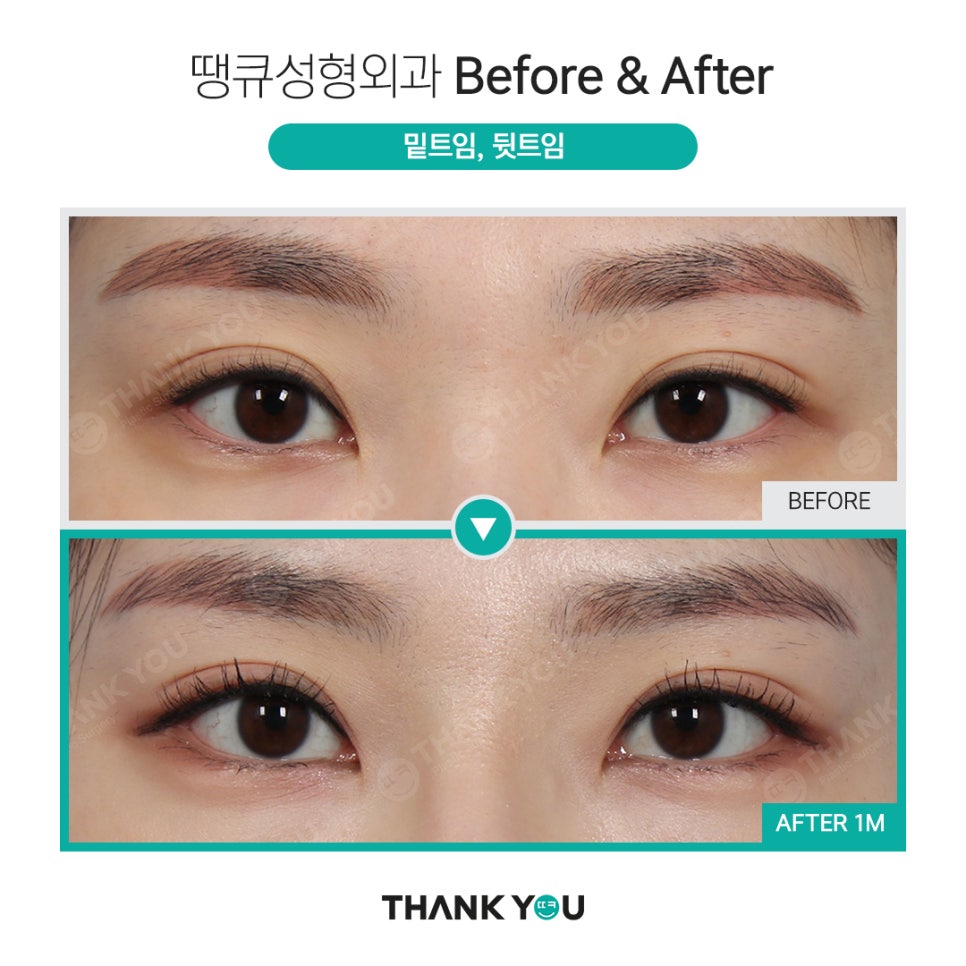 쌍수 뒷트임 (앞트임,밑트임, 듀얼트임 종류) 전후사진 관련 이미지 13
