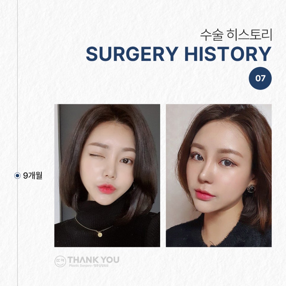 코필러 대신 여자코성형 (콧대+코끝)자연스럽게 관련 이미지 10