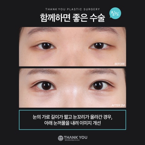 눈매교정잘하는곳 땡큐에서 더 또렷하게, 더 자연스럽게! 관련 이미지 9
