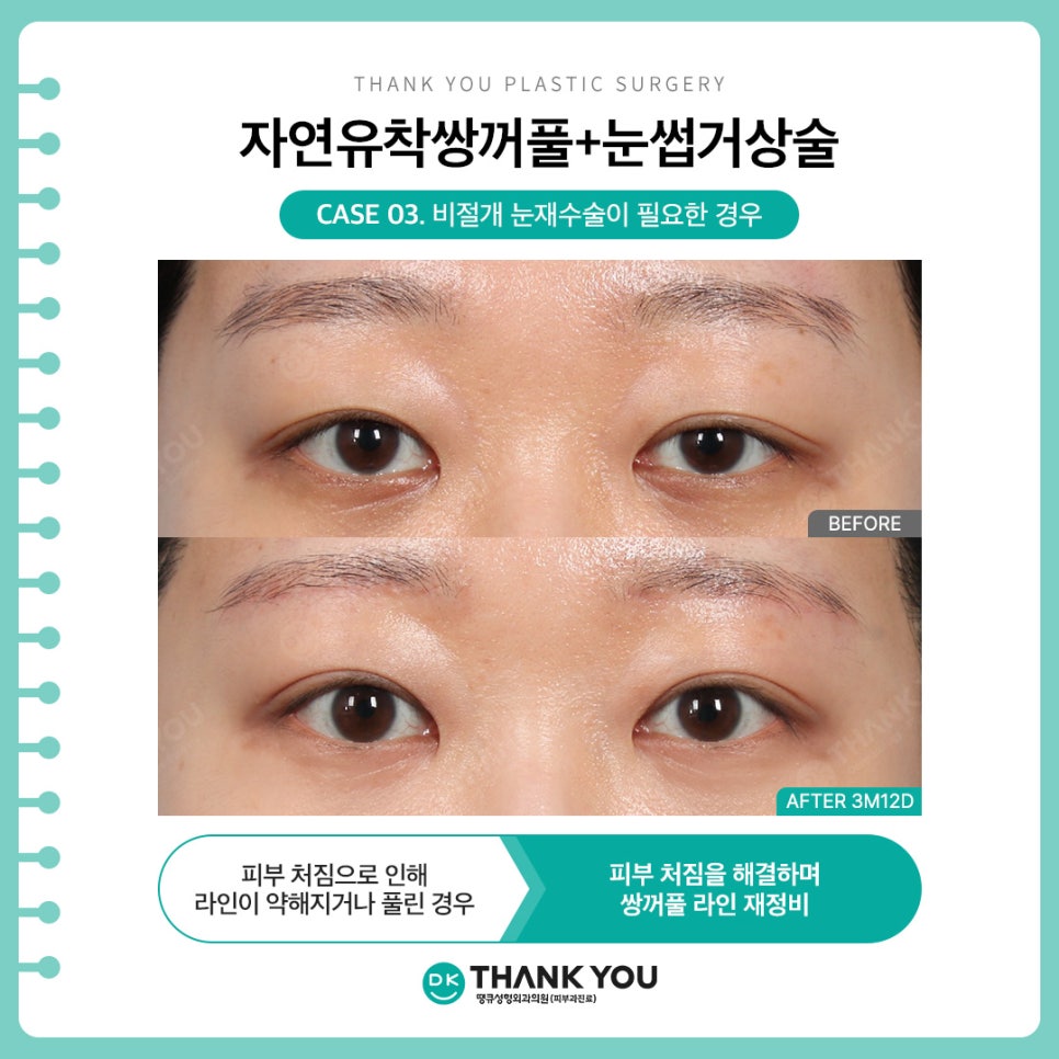 자연유착쌍커풀 + 눈썹하거상술, 자연스러운 라인에 처진 눈 개선까지?! 관련 이미지 6