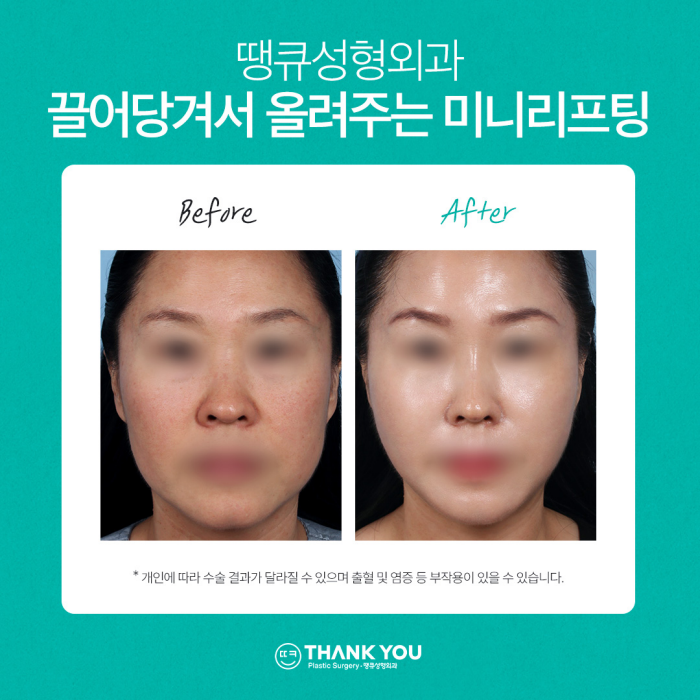 미니리프팅, 탄력과 주름을 동시에 개선하는 동안시술🤗 관련 이미지 10