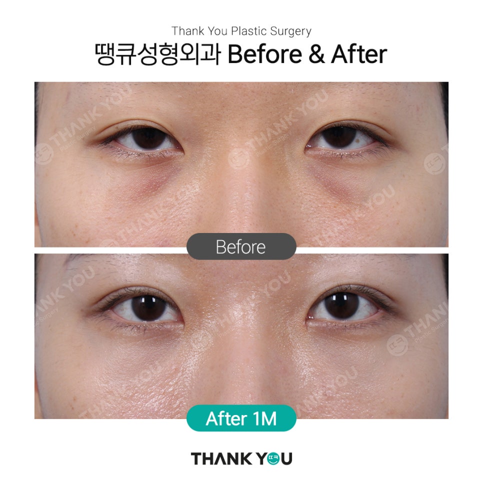 땡큐에서 알려드리는 눈밑지방재배치 Check point ❗ 관련 이미지 7