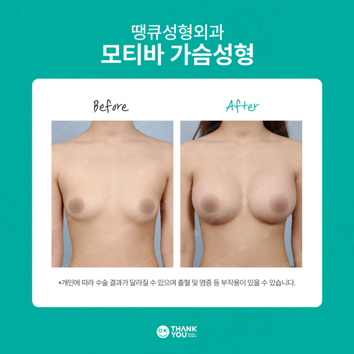 땡큐성형외과 모티바가슴성형 이벤트✨ 관련 이미지 12