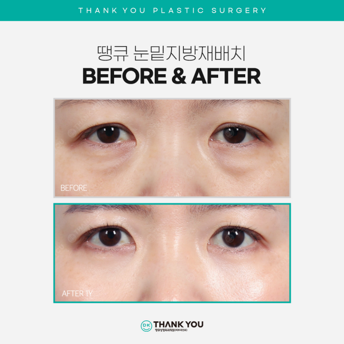 Recommended Under-Eye Fat Repositioning! Transform Your Look to Be Brighter and More Vibrant! image 2