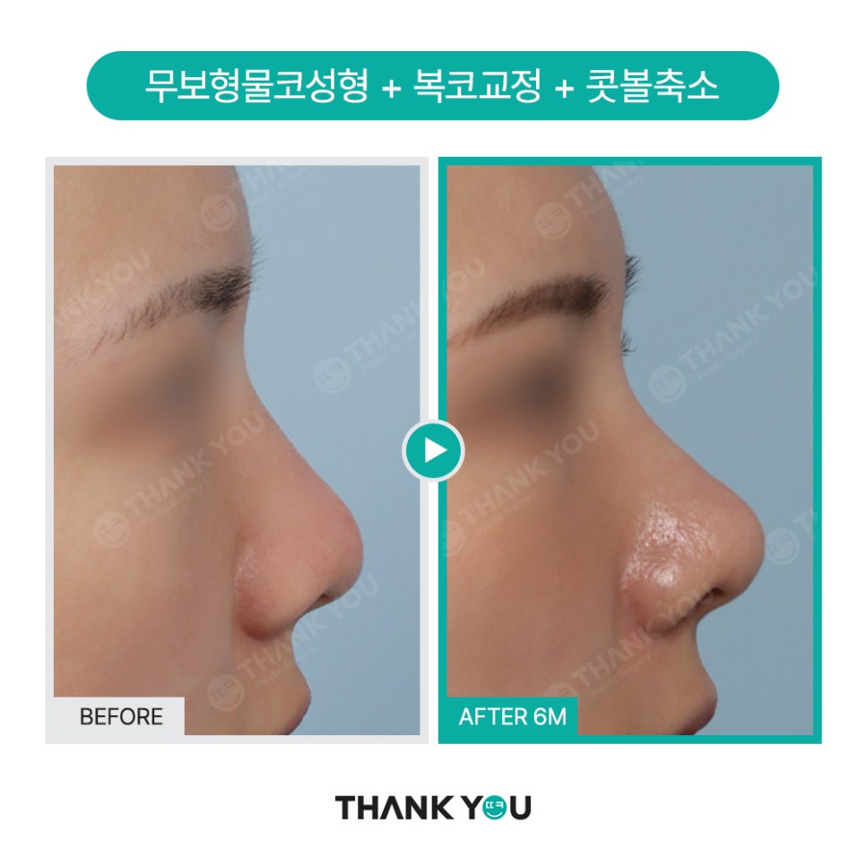 이런 코는 무조건 성공?! 코성형 성공 유형 관련 이미지 15