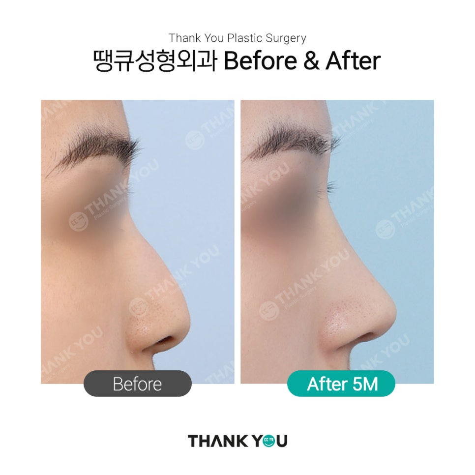 남자코성형 여자코성형 디자인 차이점 (코성형 전후) 관련 이미지 5