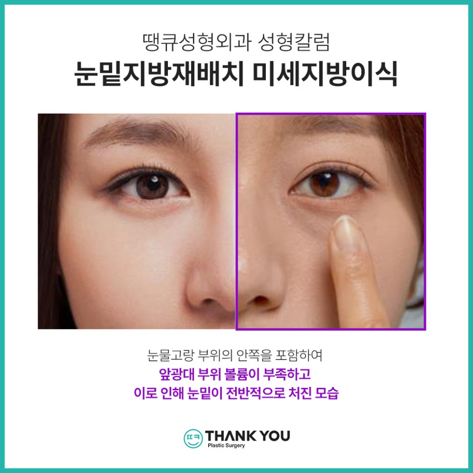 눈밑지방재배치 함께 필요한 미세 지방이식?(땡큐 나노펫) 관련 이미지 2