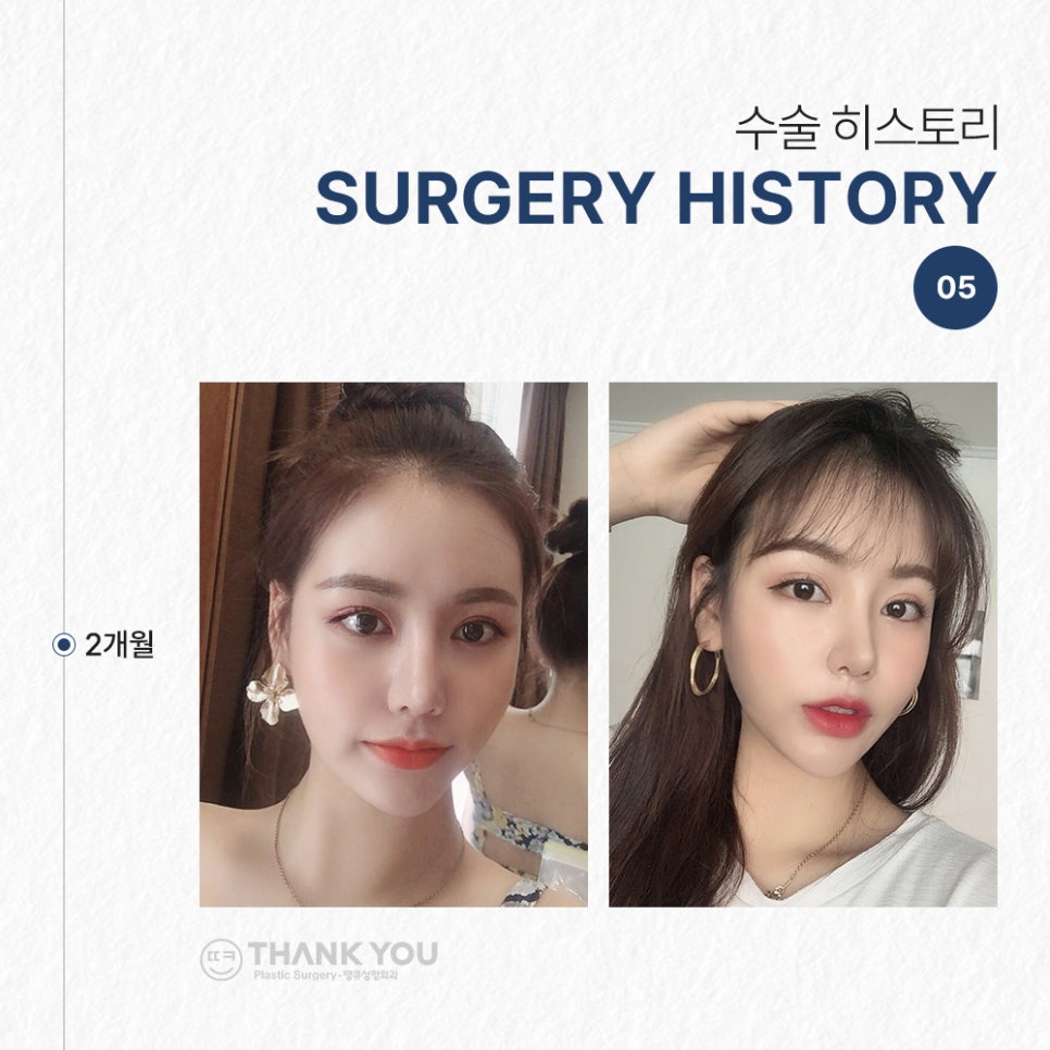 코필러 대신 여자코성형 (콧대+코끝)자연스럽게 관련 이미지 8