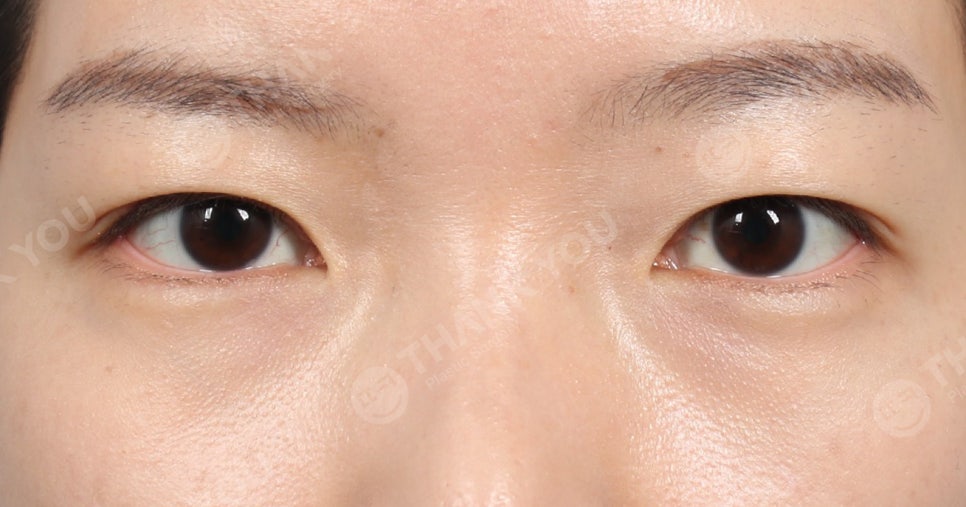 '쌍꺼풀 실 눈찌름'으로 안과? 쌍수실 제거+자연유착 라인 살리는 법 관련 이미지 23