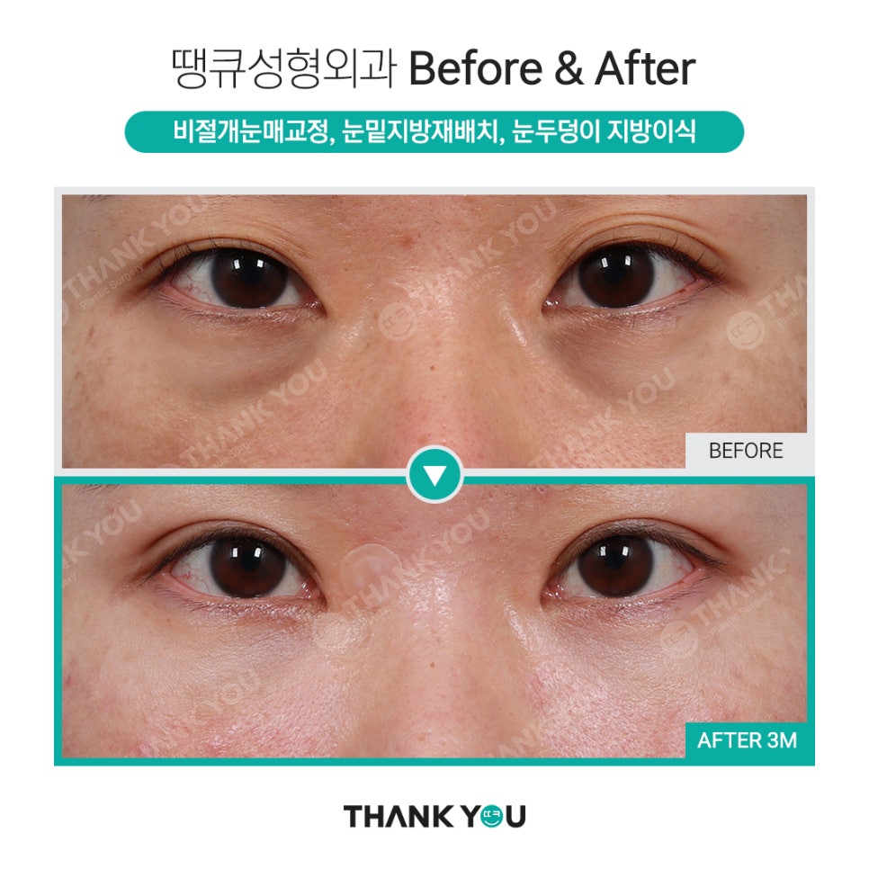 하안검과 눈밑지방재배치의 차이점? 관련 이미지 12