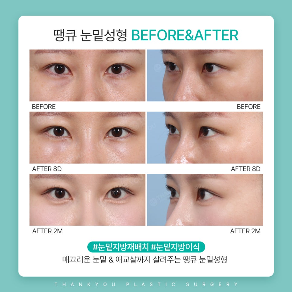 눈밑지방재배치수술만으로 볼륨이 부족하다면? 관련 이미지 5