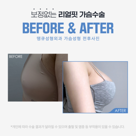 가슴지방이식수술 경험이 있을 경우, 재수술에 해당될까? 관련 이미지 5