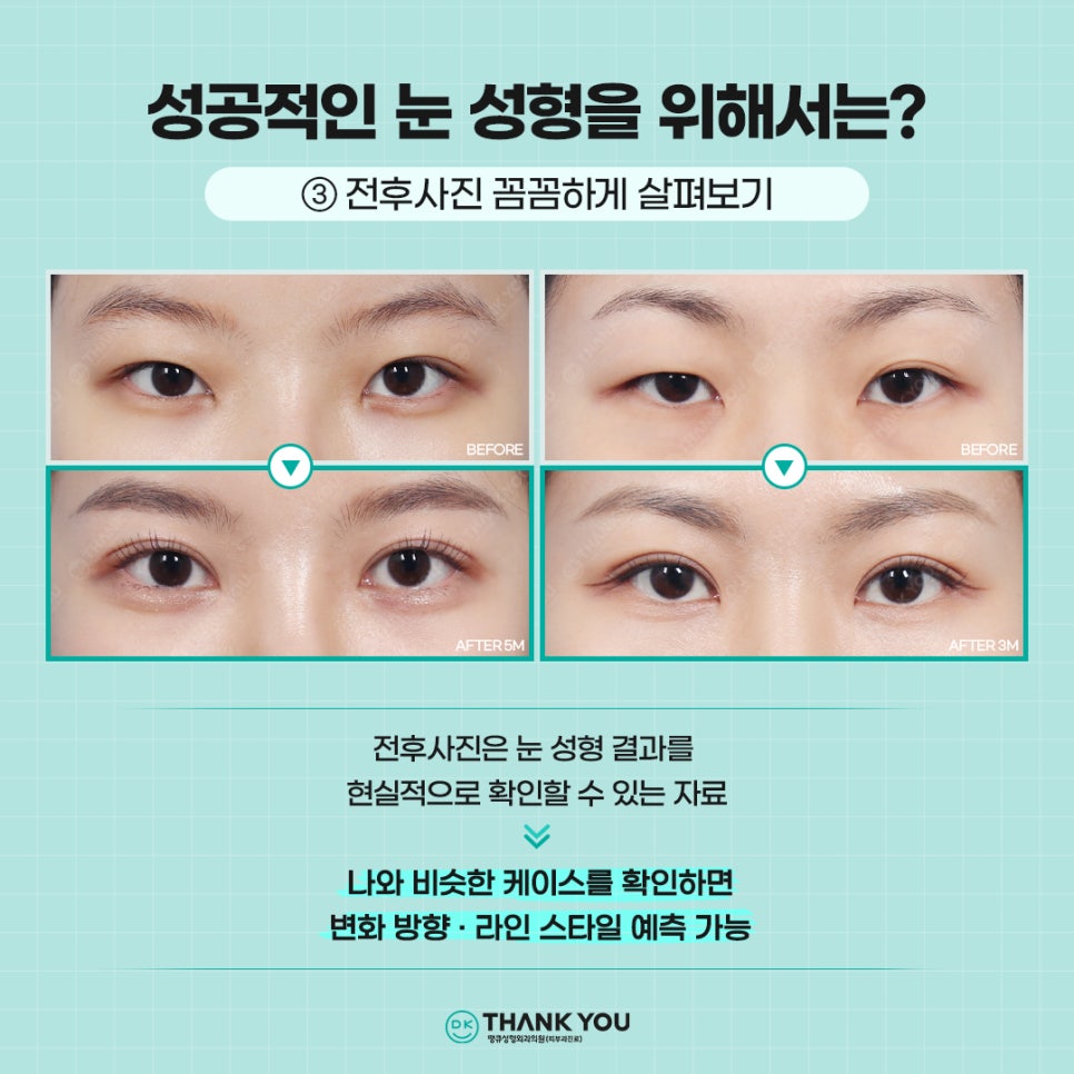 첫눈성형, 자연스럽고 조화로운 결과를 위해서는?! 관련 이미지 7