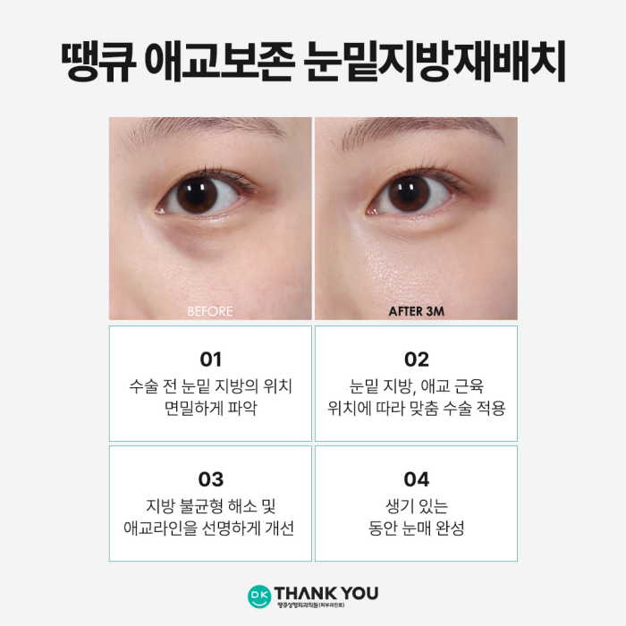 눈밑지전후 애교살에 변화가 생길까? [김다솜 원장 칼럼] 관련 이미지 5