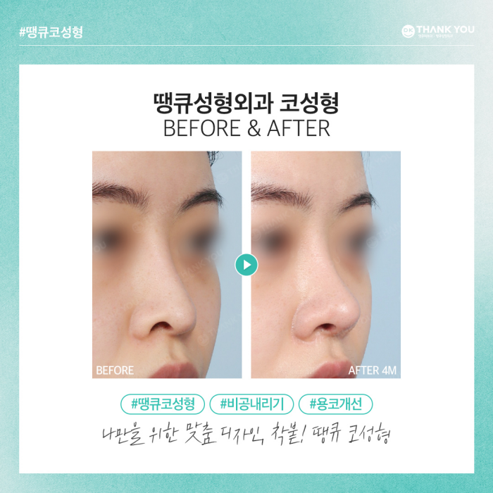 비공내리기로 용코교정하고 조화로운 코 만들기🍀 관련 이미지 7