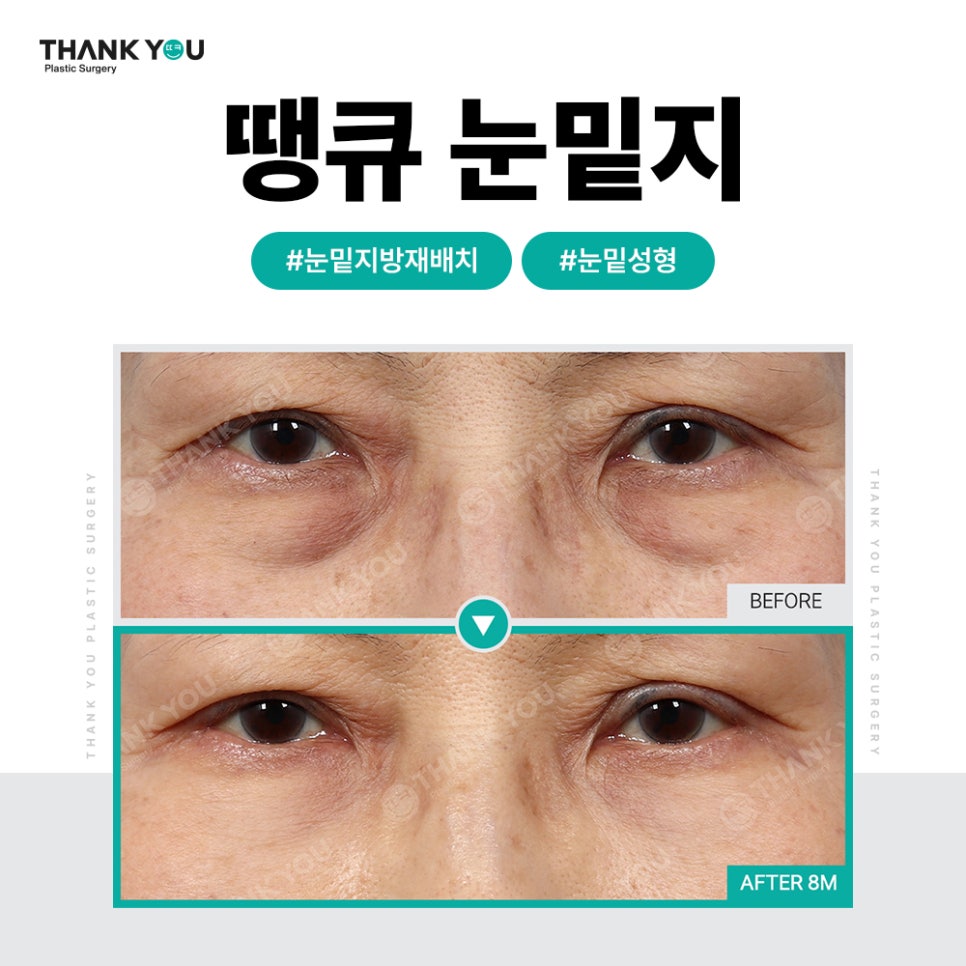 눈밑 불룩, 눈밑지 대신 눈밑지방제거만 단독으로? 관련 이미지 12