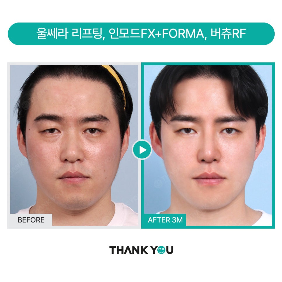 MAKE미남(맥미남) 오덕차장님의 노안 개선&남자 비염코성형 전후 관련 이미지 15