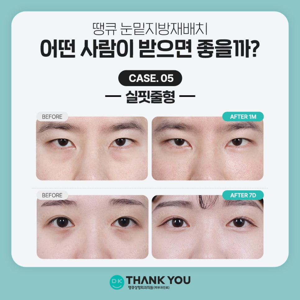 Under-Eye Fat Repositioning Event! Special Benefits for Exam Takers Prepared by Thank You 💫 image 8