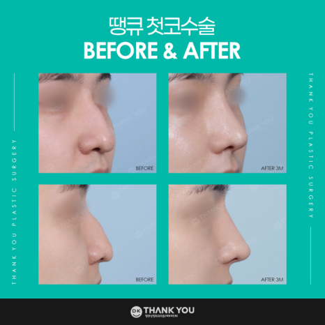 첫코수술 성공을 위해 고려해야 할 점은? 관련 이미지 10