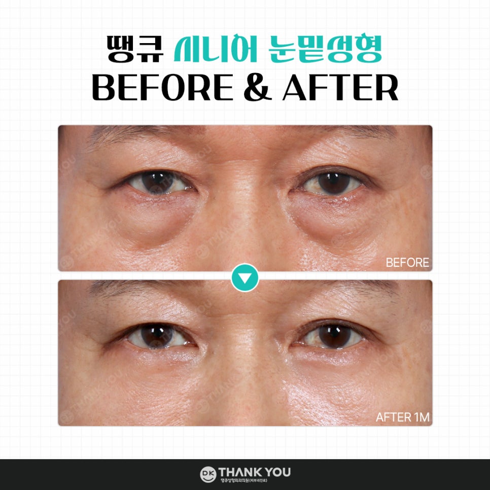 눈밑성형, 연령별로 달라지는 수술법! 무엇이 다를까? 관련 이미지 9