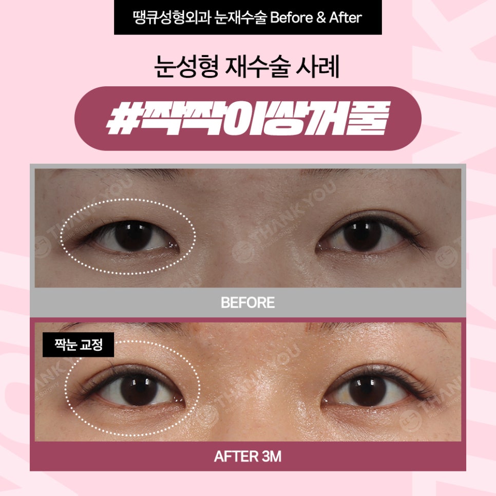 짝눈 교정, 쌍수 재수술 시기 알려드려요 관련 이미지 7