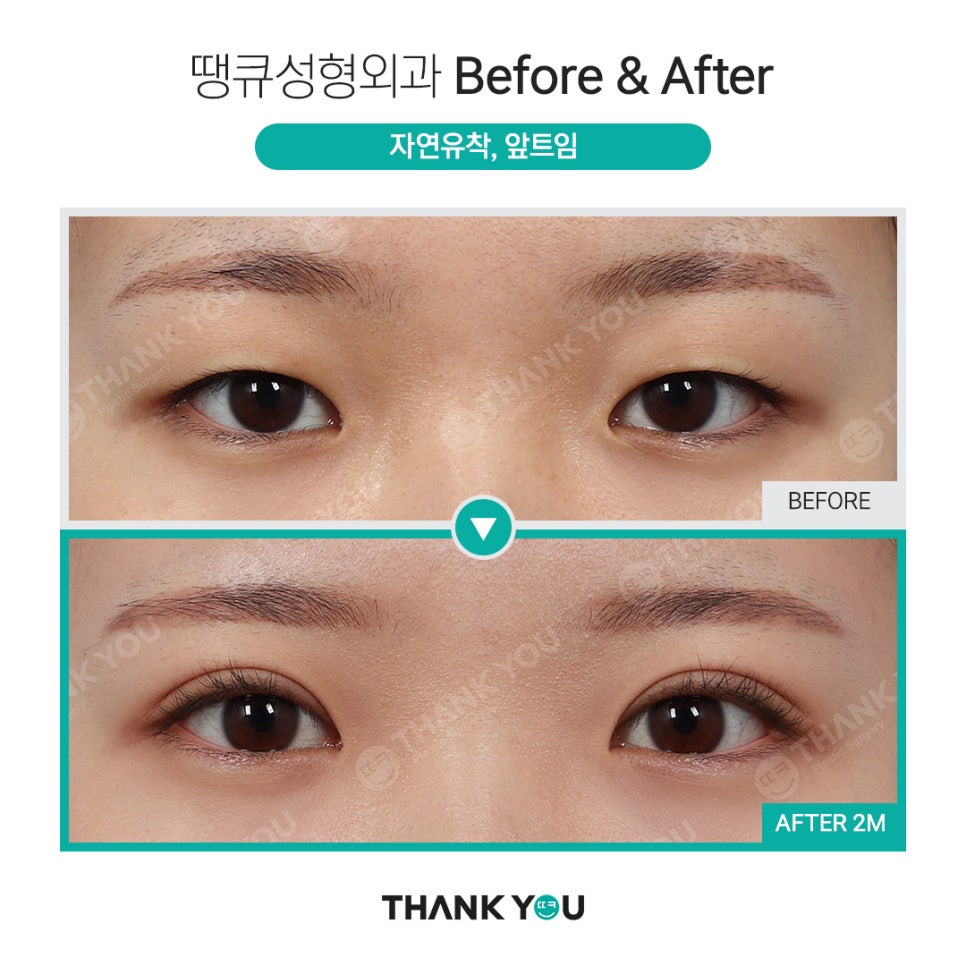 신논현역 성형외과에서 쌍수 전후 Check✨ 관련 이미지 5
