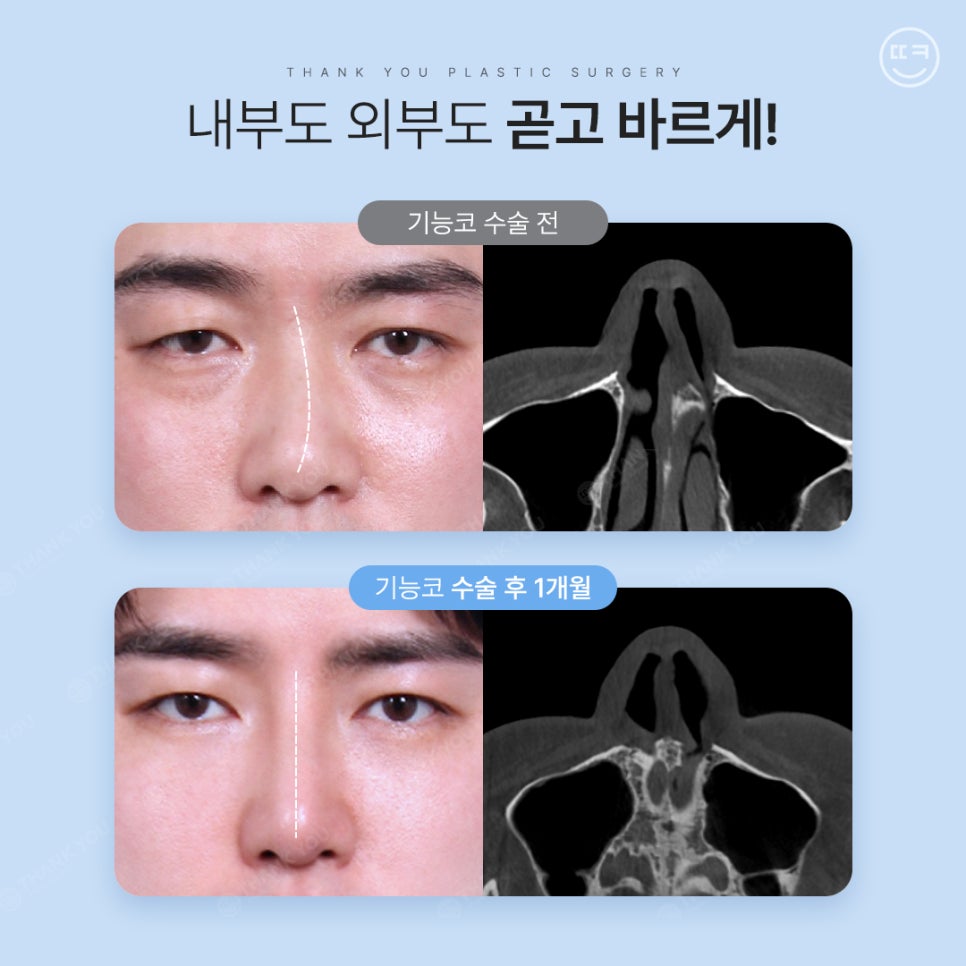 [맥미남 병원] 남자 휜코 성형, 막힌코수술, 코막힘 등 전후 까지 관련 이미지 15