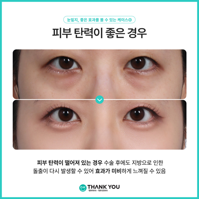 눈밑지병원에서 알려주는 눈밑지방재배치 추천 대상! 관련 이미지 5
