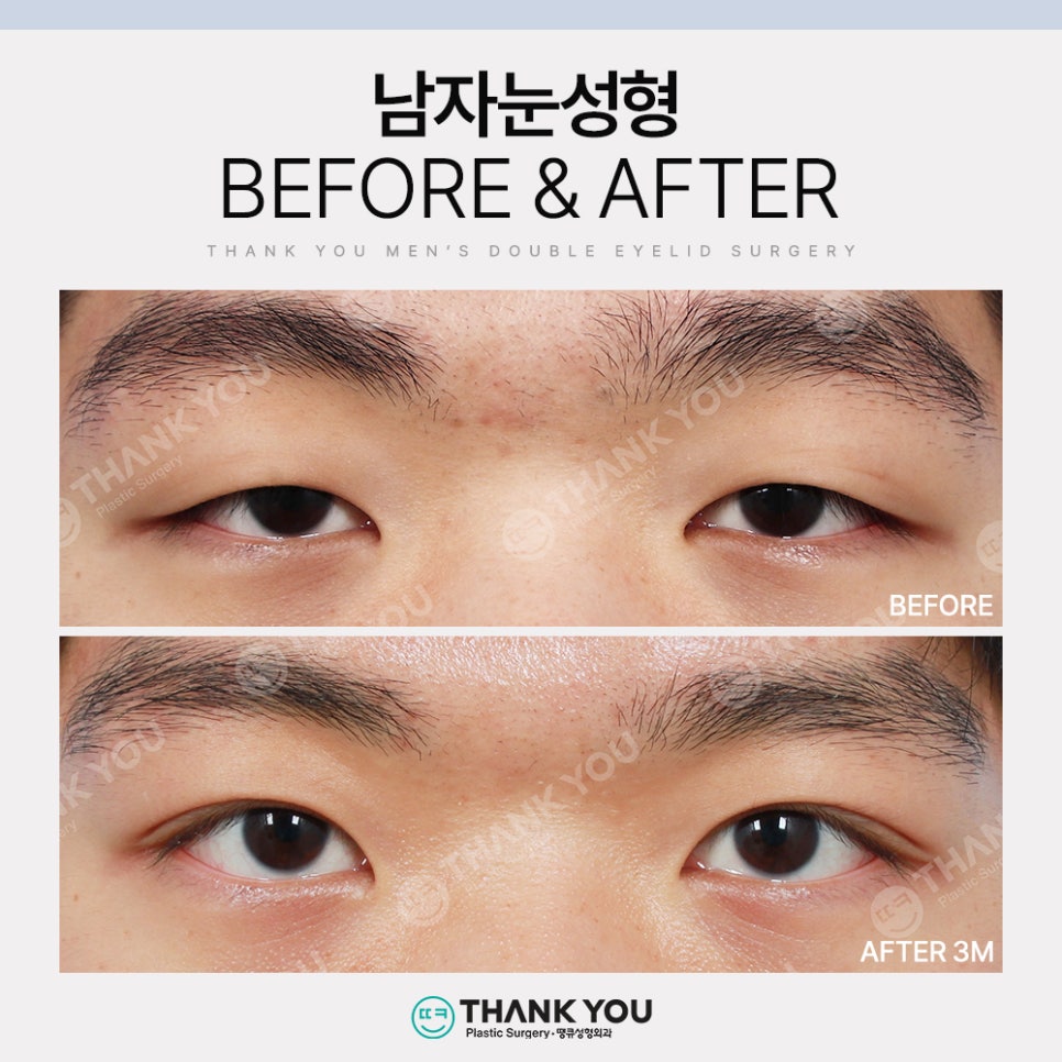 땡큐 남자눈성형 솔루션 (ft. 남자비절개 눈매교정 전후) 관련 이미지 10