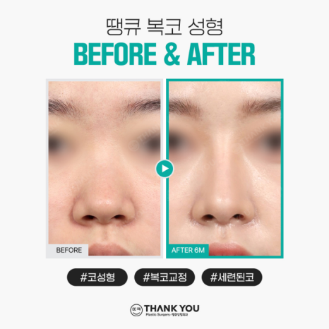 복코성형, 꼭 코뼈절골을 해야할까요? 관련 이미지 9