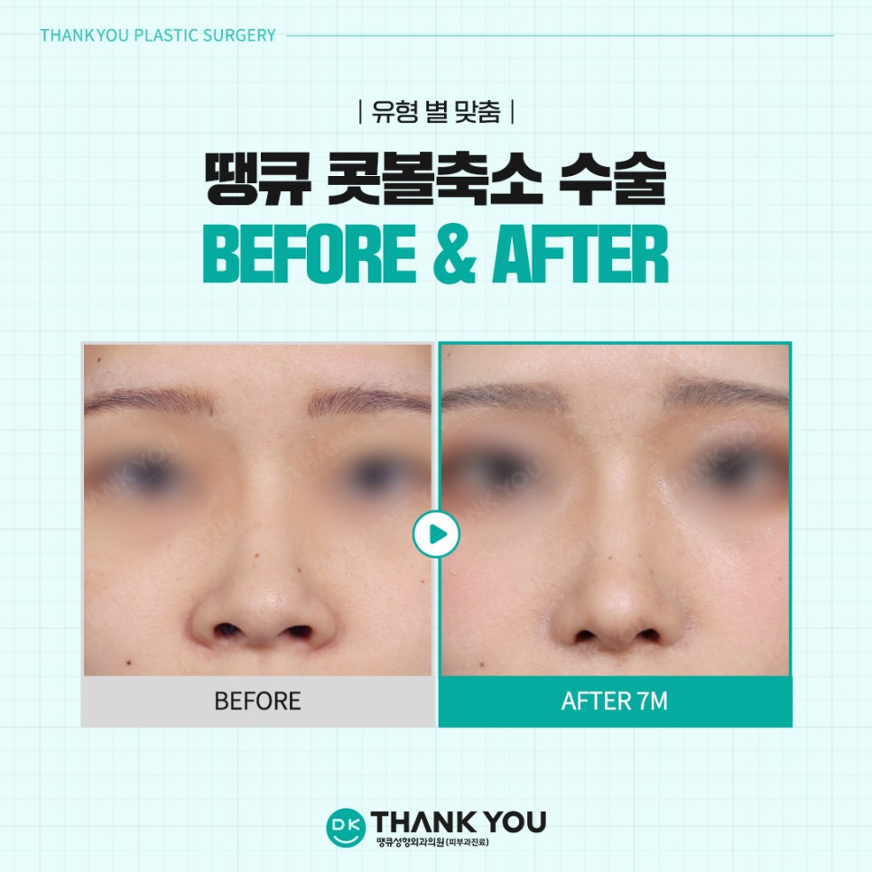 Rhinoplasty Before and After? See the Stylish Nose Created at Thank You Here! image 9