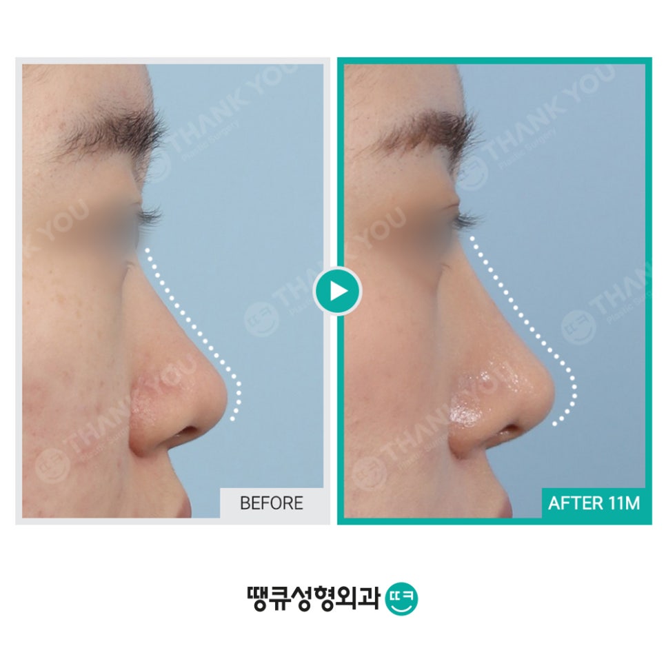 숨이 잘 안쉬어져요 실비코성형 비염도 기능코로 라인 커버! 관련 이미지 5