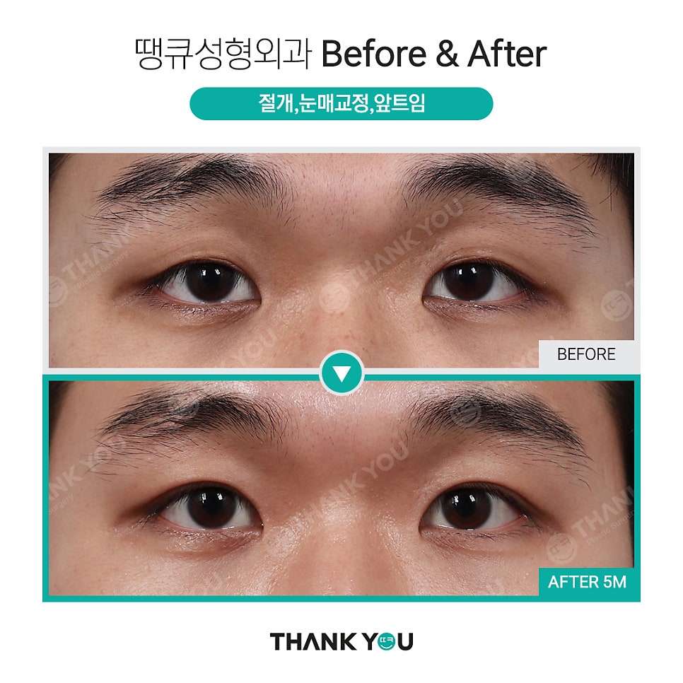 남자 쌍수 전후, 관련 이미지 2