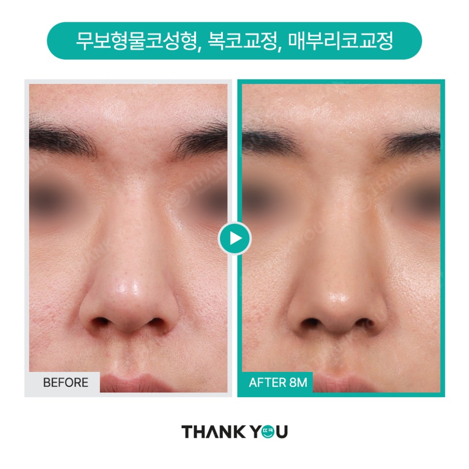 남자코성형 (휜코, 매부리코 등) 기능코성형 필요! [ft.코수술전후] 관련 이미지 17