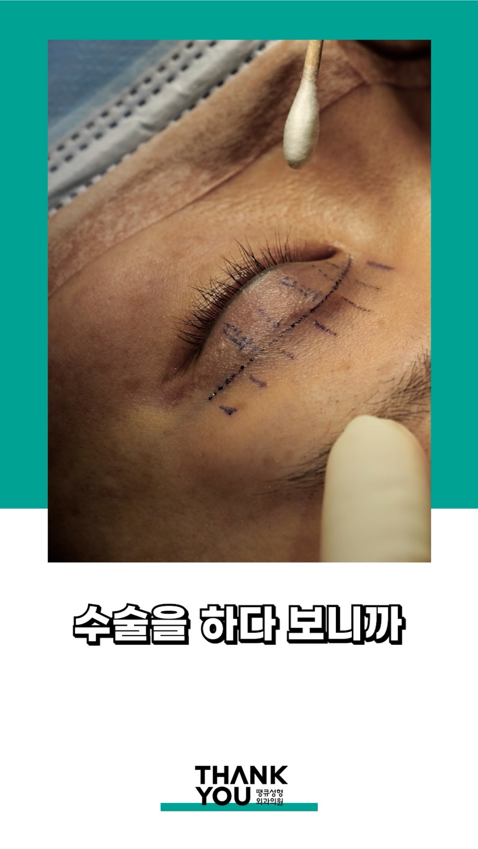 3번 눈재수술? 근데 실제거를 안했다고? 땡큐에서 전부 실제거! 관련 이미지 6