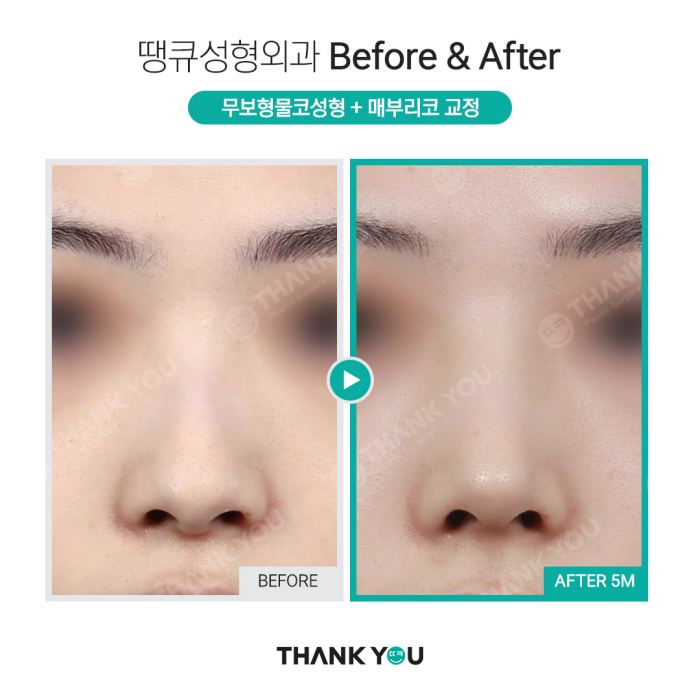 첫코성형, 자연스러운 결과를 원한다면?! >> 무보형물코성형 관련 이미지 7