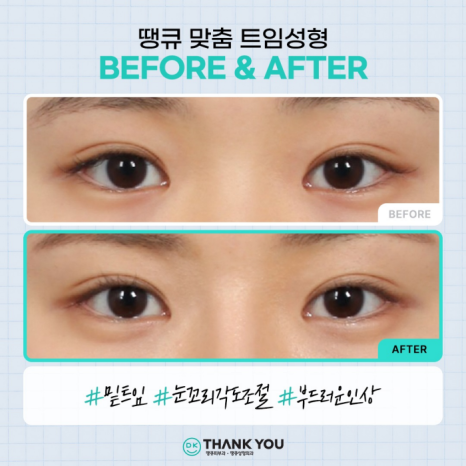 트임성형잘하는곳에서 알려주는 트임 위치별 특징 관련 이미지 7