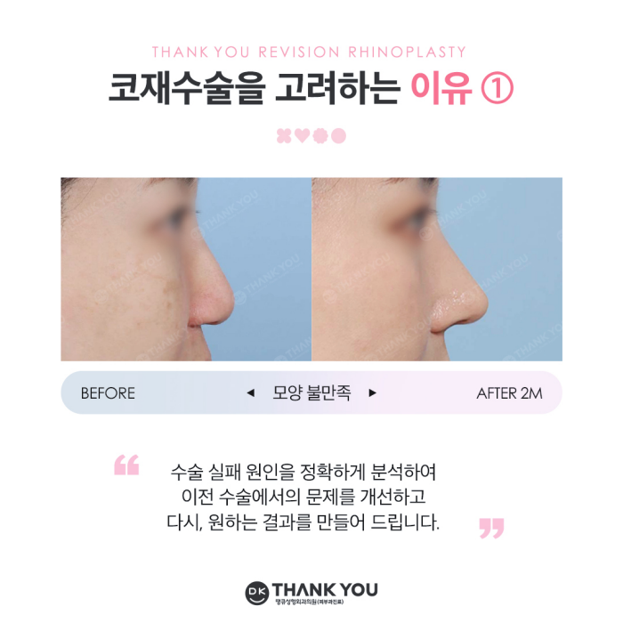코재수술잘하는병원 땡큐 이벤트✨ 관련 이미지 2