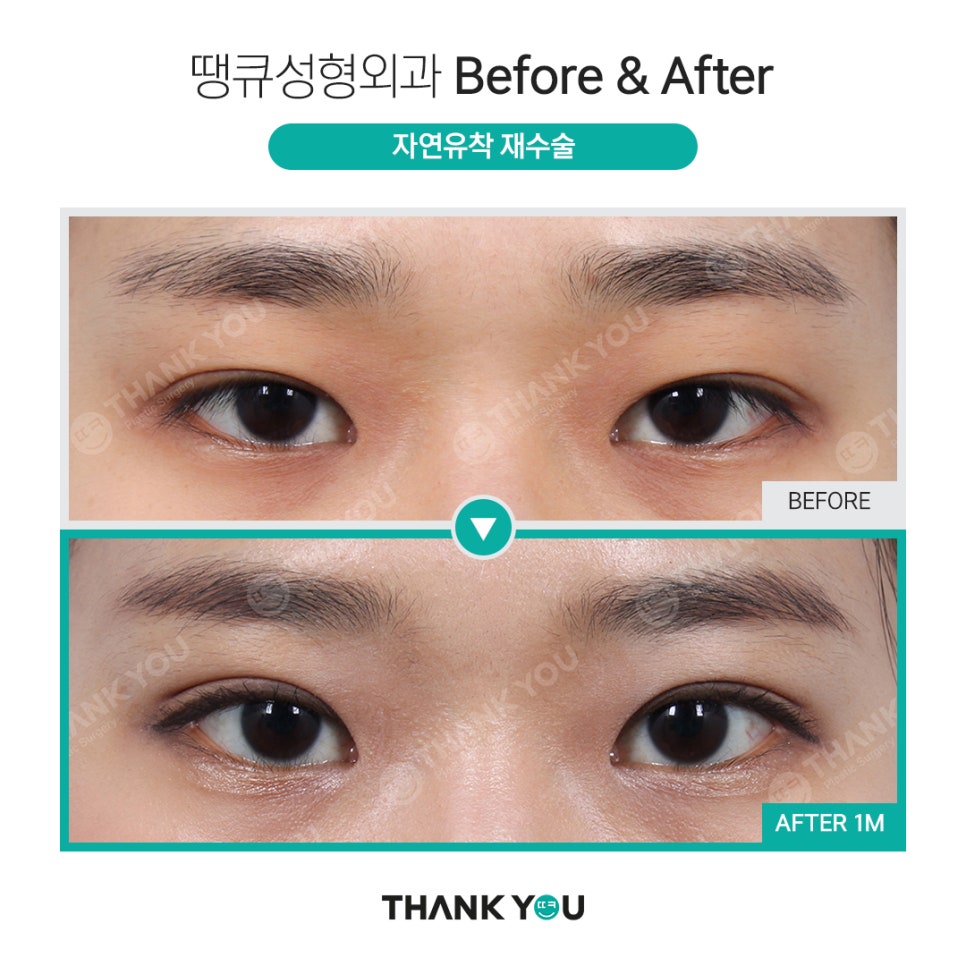 쌍수 풀기 (재수술전 실풀기+ 눈재수술 전후) 관련 이미지 14