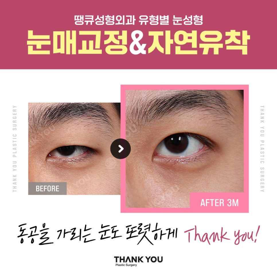 신논현역 성형외과에서 쌍수 전후 Check✨ 관련 이미지 11