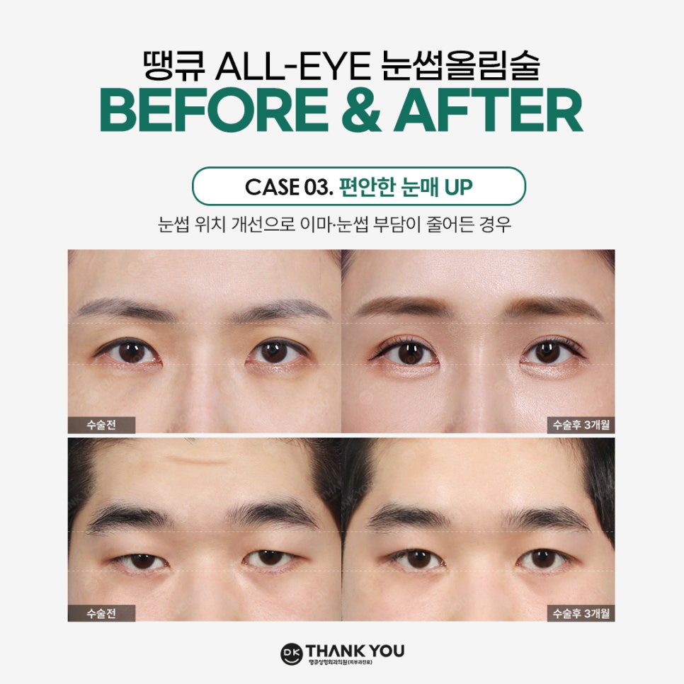 Improving Drooping, Tired-Looking Eyes in One Go with Forehead Lift Surgery! image 6