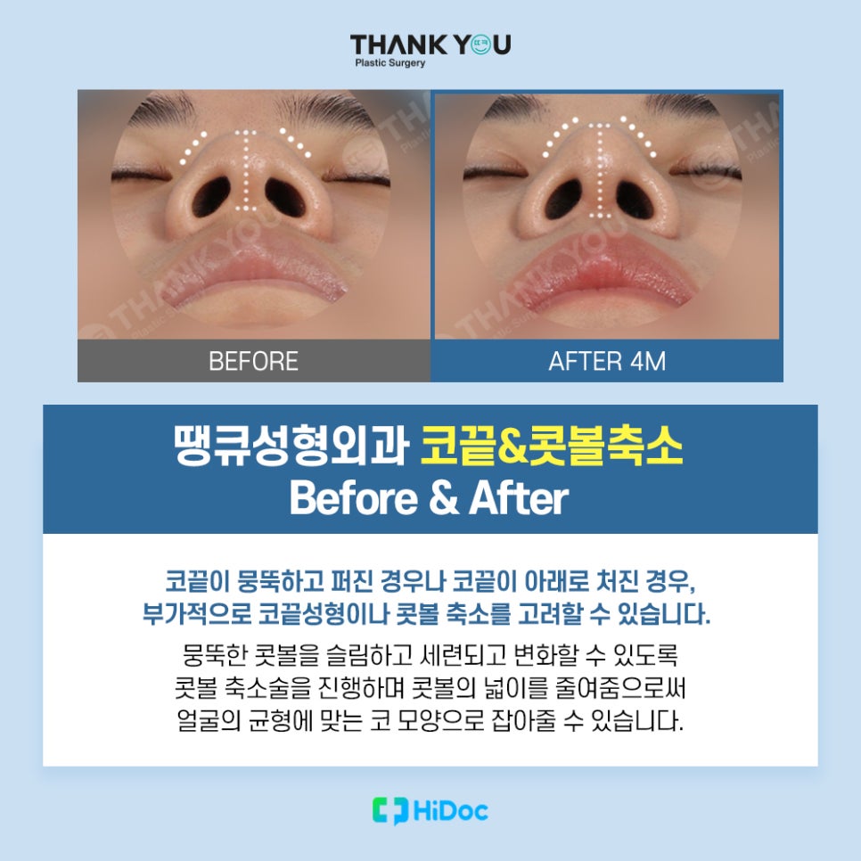 코성형 종류, 보형물과 콧대 라인까지 니즈 체크 관련 이미지 8